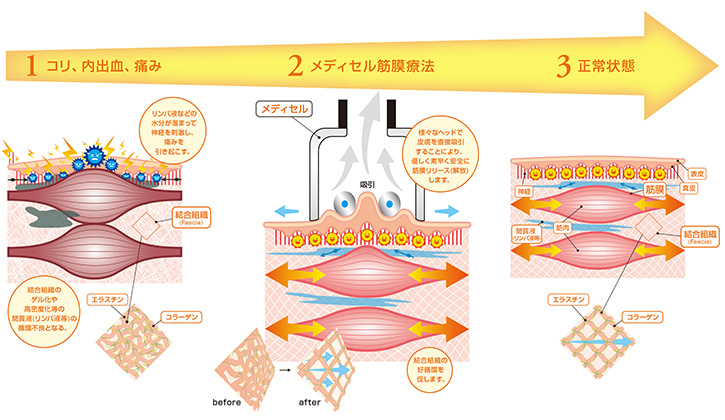 筋膜リリース療法・メディセル 画像3